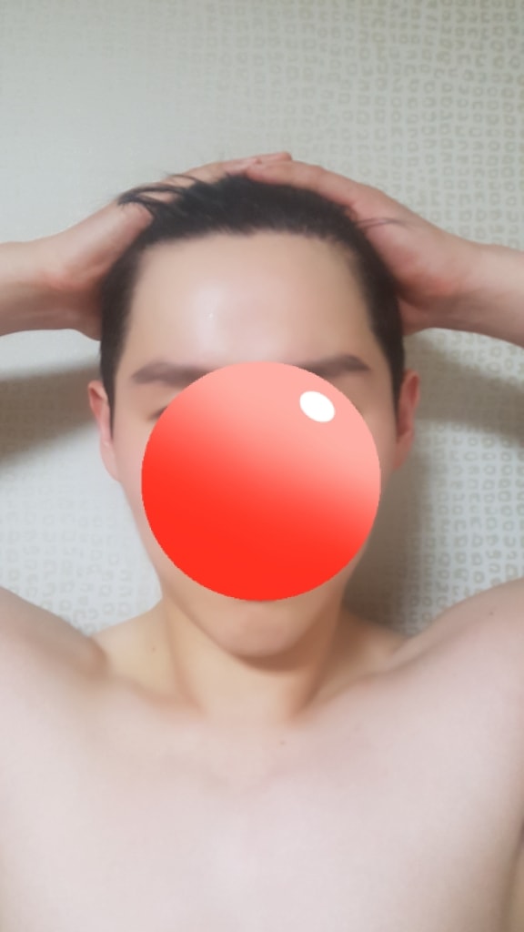 모재성 수술후기 8개월차