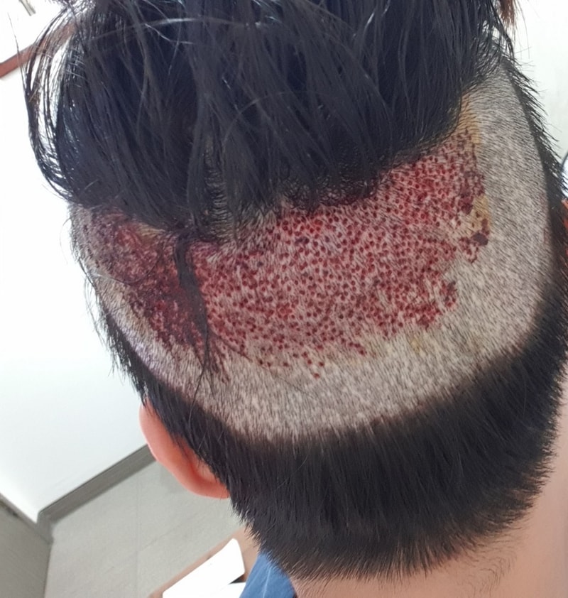 비절개 모발이식 수술직후 후기올립니다.