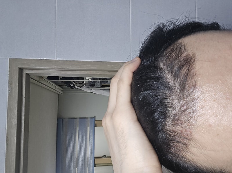 이식3개월2.jpg