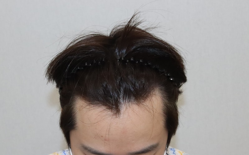 3000모 비절개 모발이식 한지 2주 지나가요