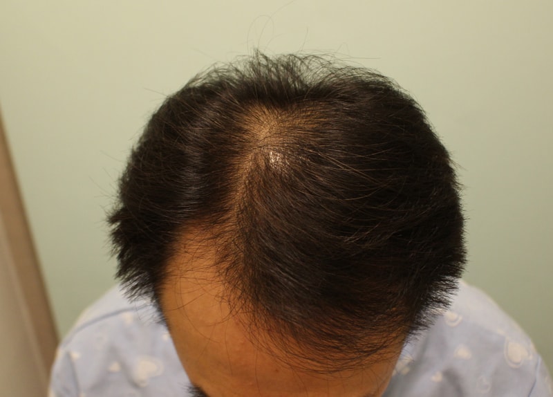 정수리탈모 모발이식 6개월입니다.