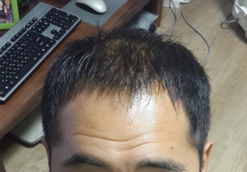수술후2일째-.jpg