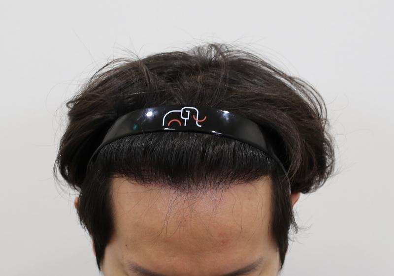 [7ヶ月目] 狎鴎亭 マンモス ヘアライン M字脱出 チンレギ
