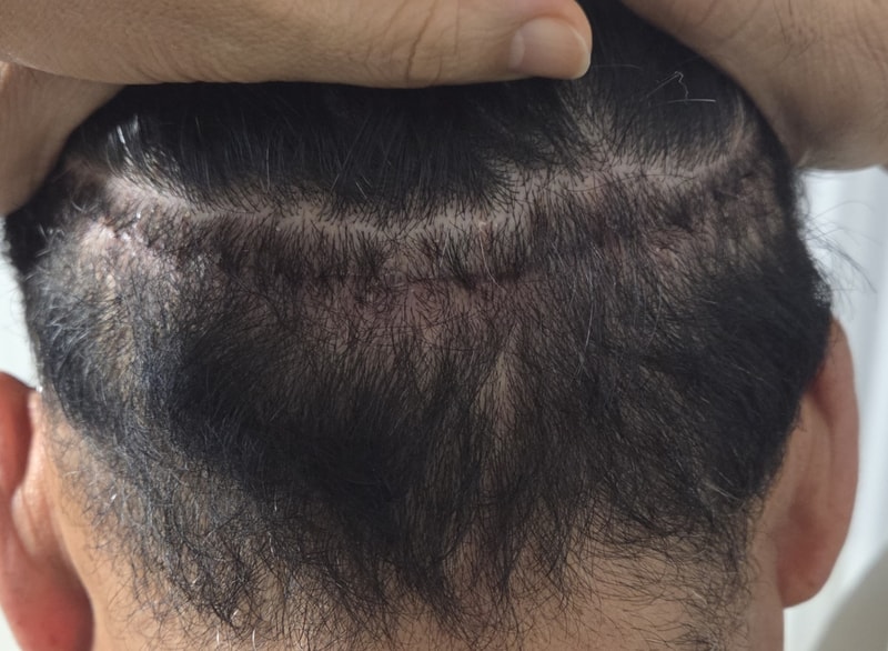 12일차 실밥제거.jpg