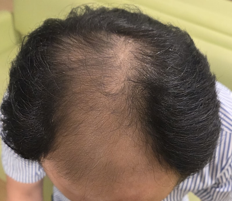 The Black Daegu Hair Transplant 5,000 wool