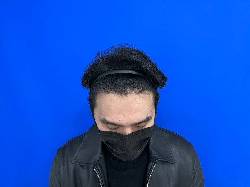 모발이식6개월.jpg