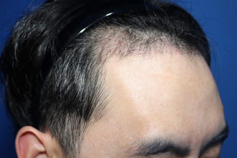 4.수술3달후.jpg