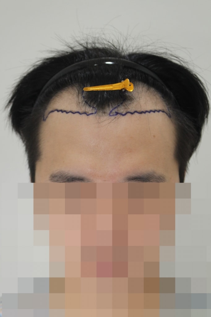 M-shape hair loss is getting better after surgery at Mo & Bless