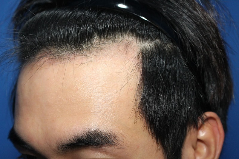 수술3개월째-2.jpg