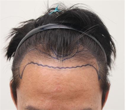 Disgusting) About 4,000 hair transplants and a month..
