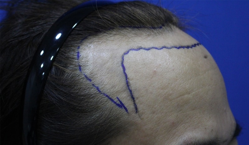 It's been a month since the first month of non-cutaneous incision, but it's growing little by little.