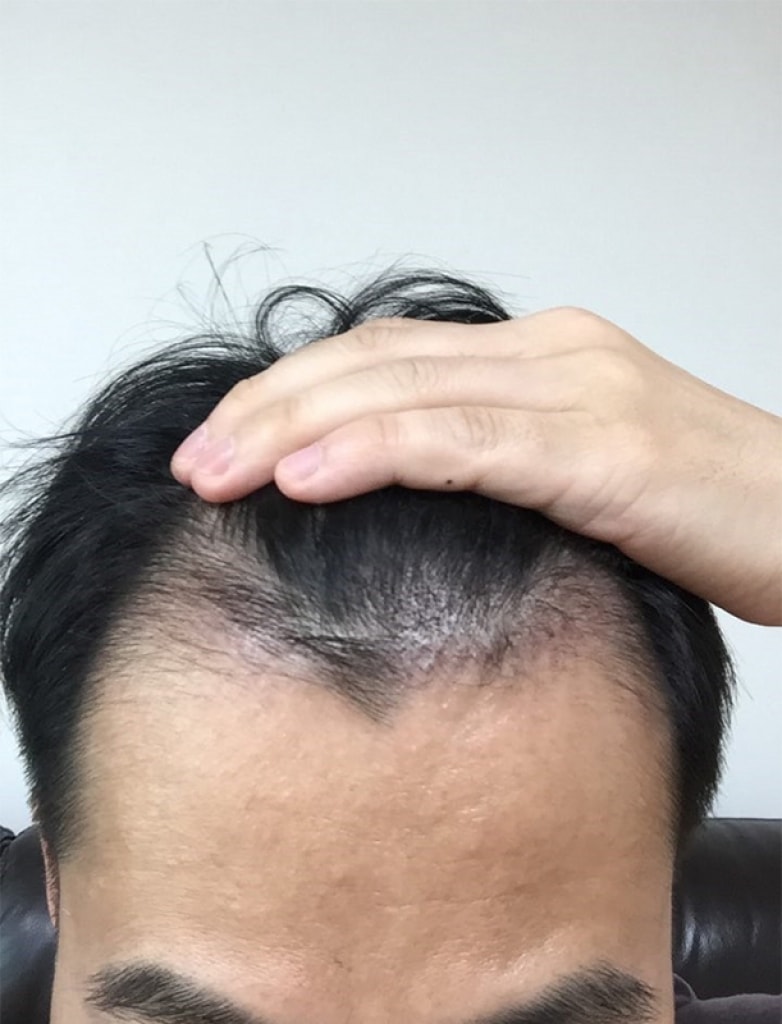 2000毛手术一个月后记呵呵