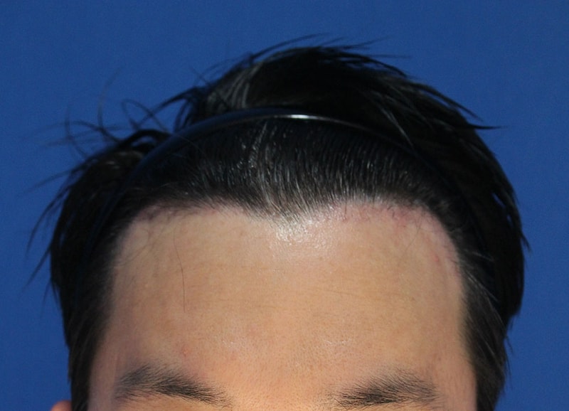 4수술1개월후.jpg