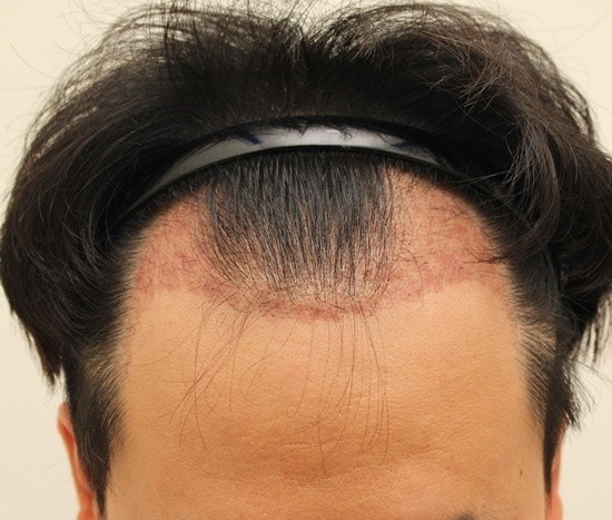手術部位の赤いのは治まりますか？