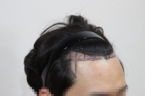 수술 전 모자이크 3.JPG