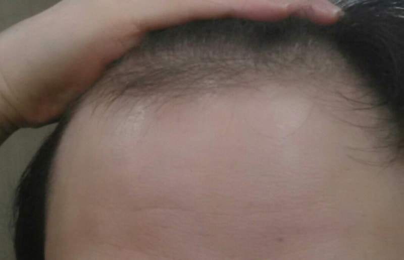 수술전.jpg