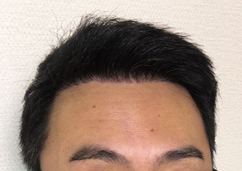 This is a progress report 9 months after surgery.