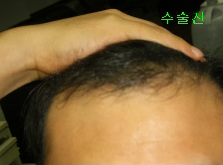 수술전-.jpg