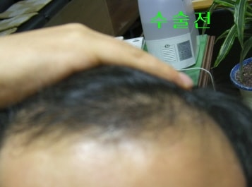 수술전.jpg