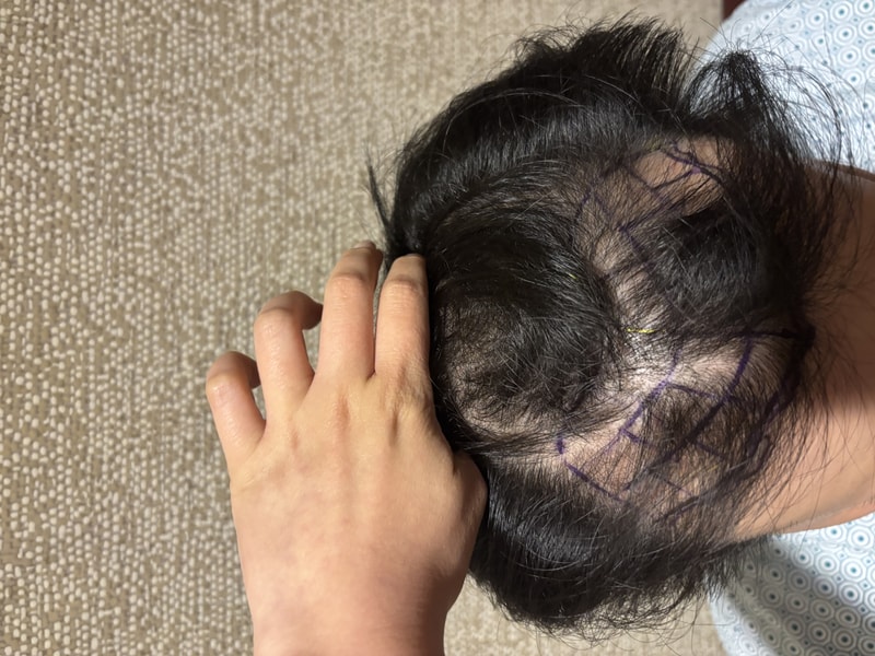 뉴헤어 비절개 모발이식 2500모낭 9개월 후기입니다 (헤어라인, 정수리)