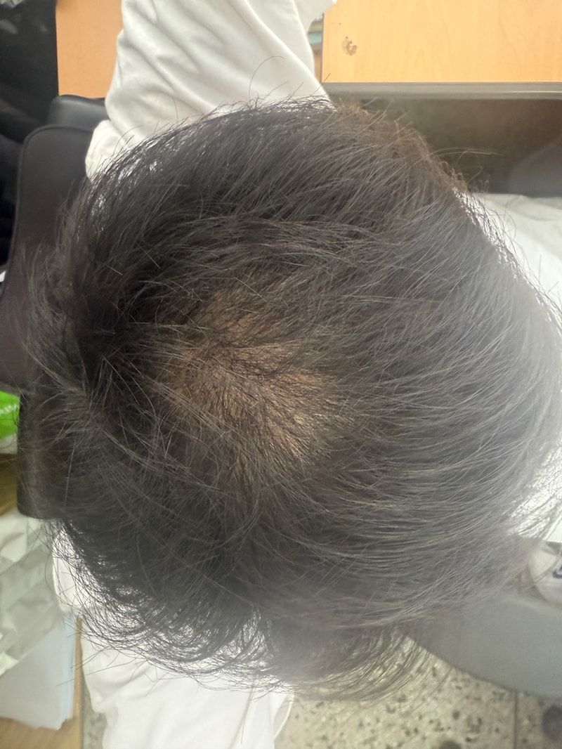 뉴헤어 비절개 모발이식 2500모낭 6개월 후기입니다 (헤어라인, 정수리)