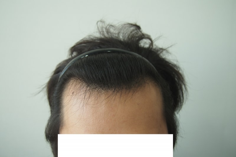 Before-정면.JPG