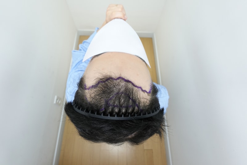 [Jarada Clinic] I transplanted about 4,500 hair follicles from 2,139.
