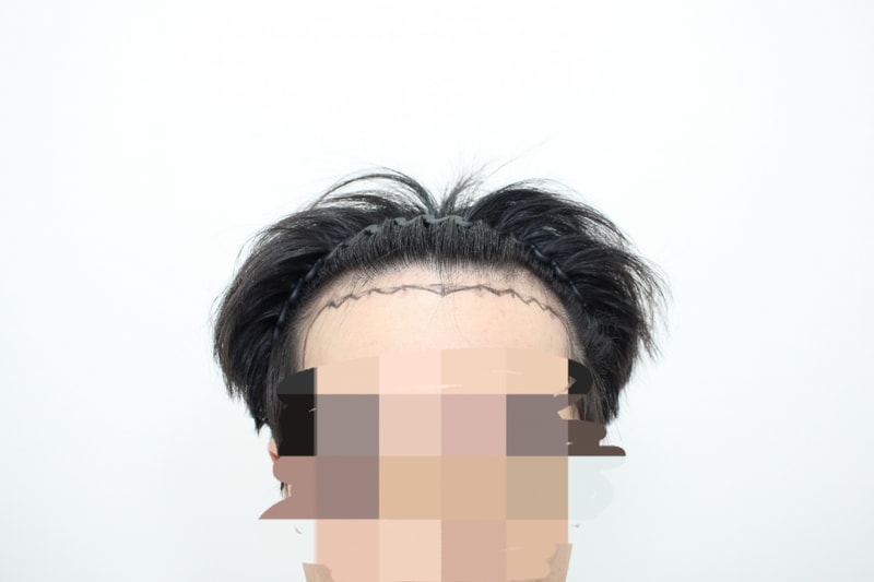 수술 전 정면.jpg