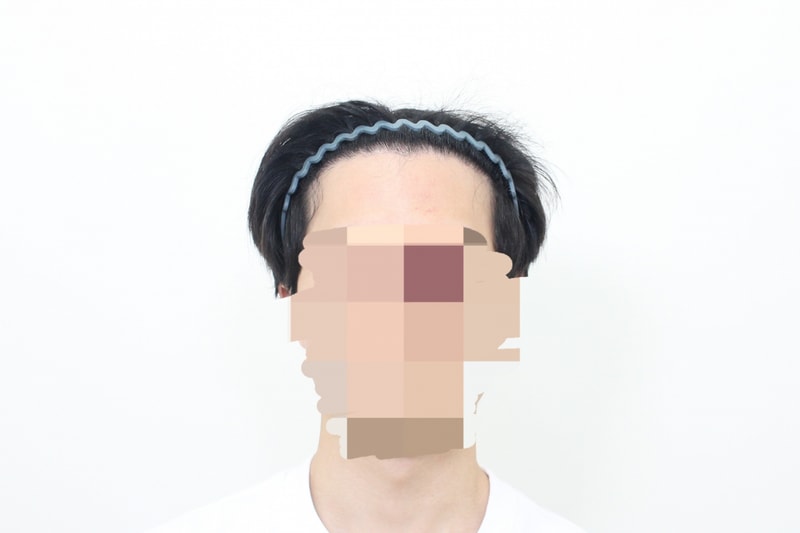 수술 후 정면.jpg