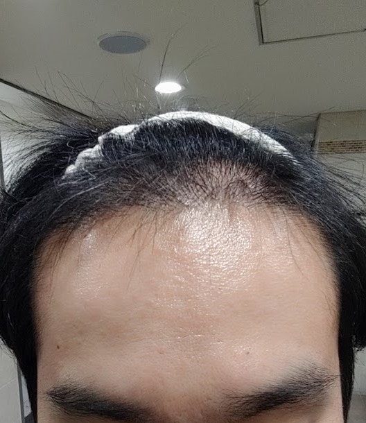 수술후 정면.jpg