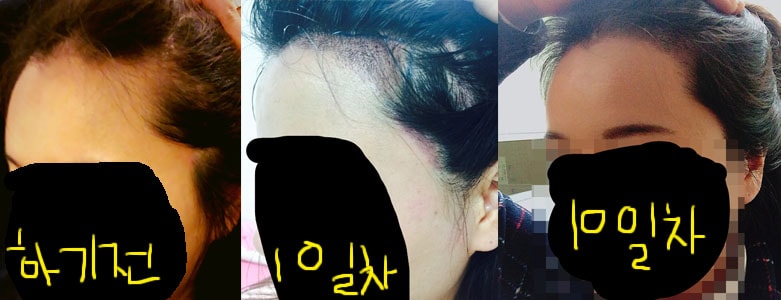 옆이마라인.jpg