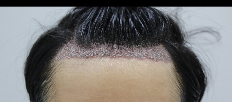 カンナムポヘア移植後、とても不満足以降A / S