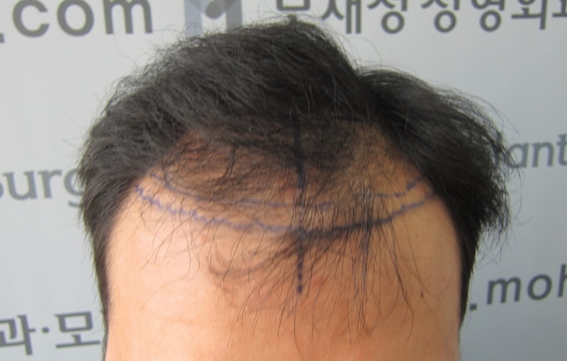 수술전.JPG