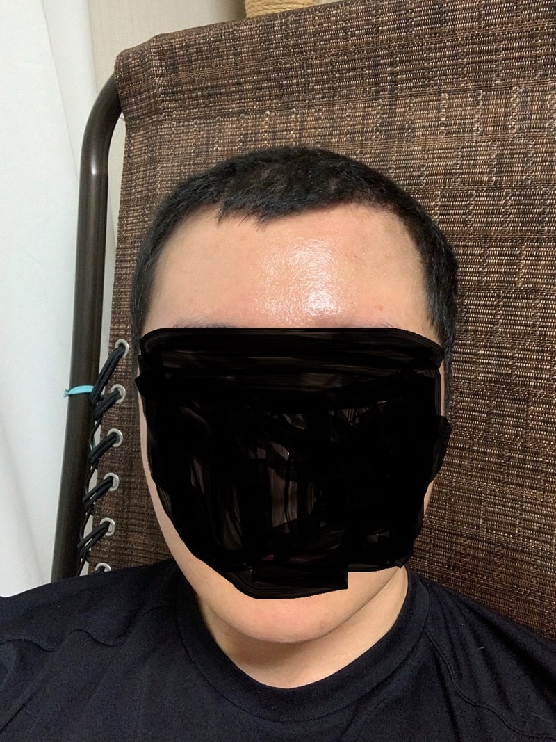 모발이식전3.JPG