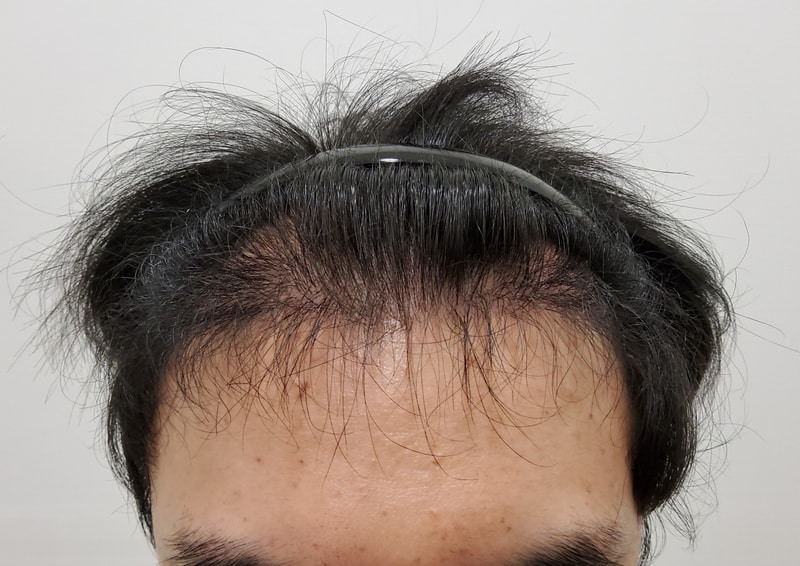 4. 수술후_6개월_1.jpg