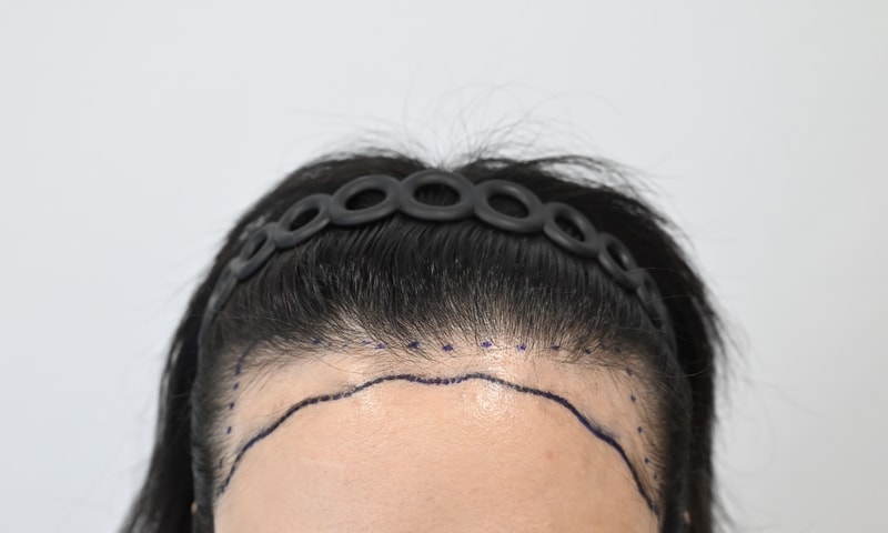 비절개 히든컷 여성 헤어라인