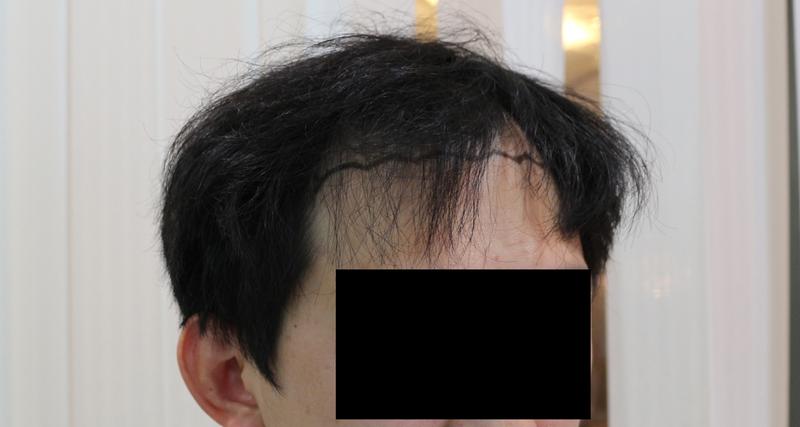 모아만의원 정수리 및 헤어라인모발이식 후기입니다