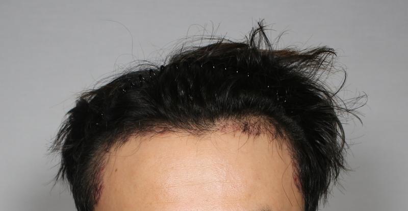 모아만의원 3200모 M자모발이식 1개월 차 후기입니다