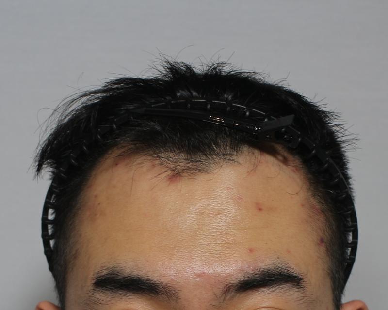 5000모 대량이식->정수리, 헤어라인 모발이식 3개월 후기-2