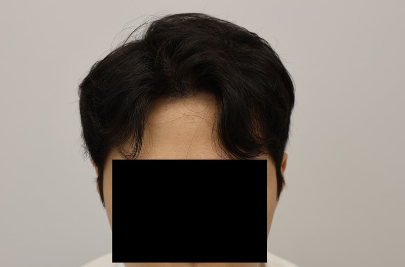 모발이식후줄기세포치료6m 2 복사.jpg