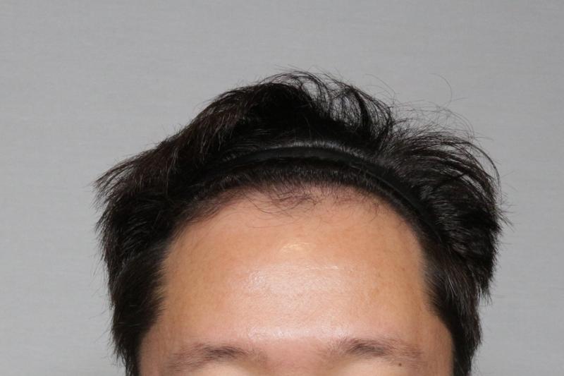 헤어라인 3500모 이식 후기 입니다(모아만의원)