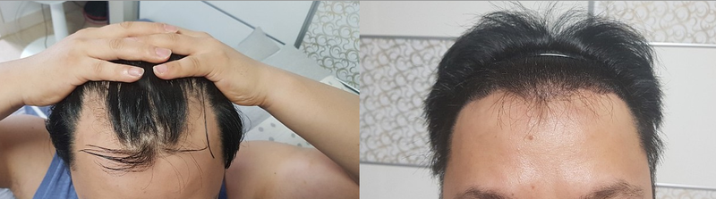 비포 엡ㅌㅌ터.PNG
