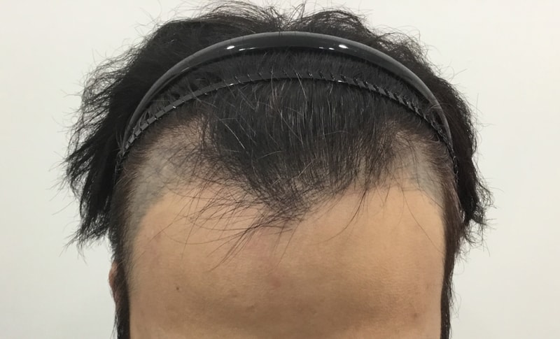 非切開 4100毛 8ヵ月目 レビュー