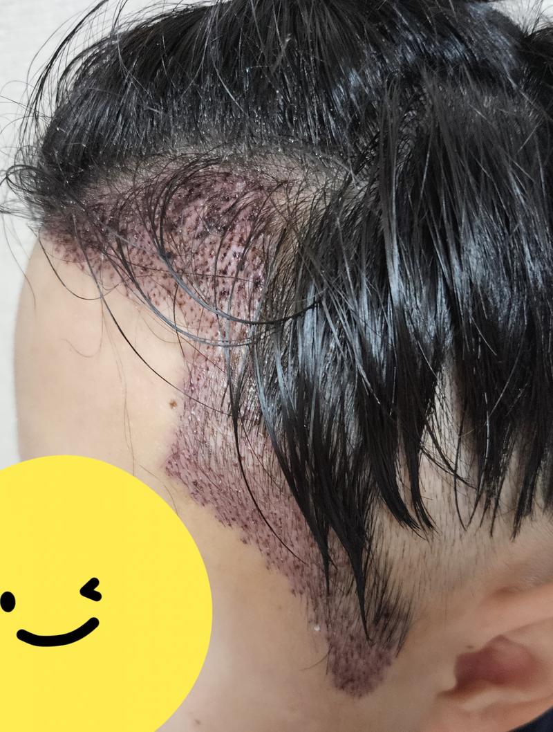 On the day of surgery~monthly progress