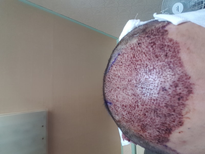 密度を見てください..非切開スリット