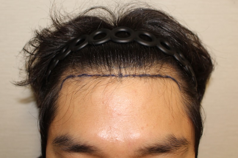 M자 모발이식 믿으니까 모다올의원