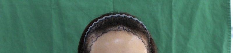 모프로 절개 모발이식 후기