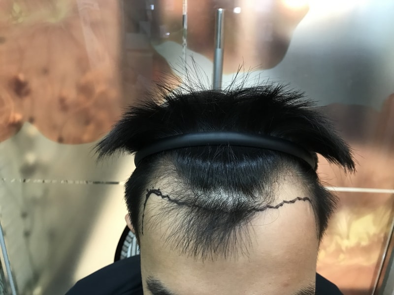 Density assessment on day one immediately after non-excision 3150 cap surgery