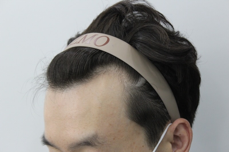 [釜山LIZMO] EMZA 脱发 3000 毛 8个月 侧脸 后记!