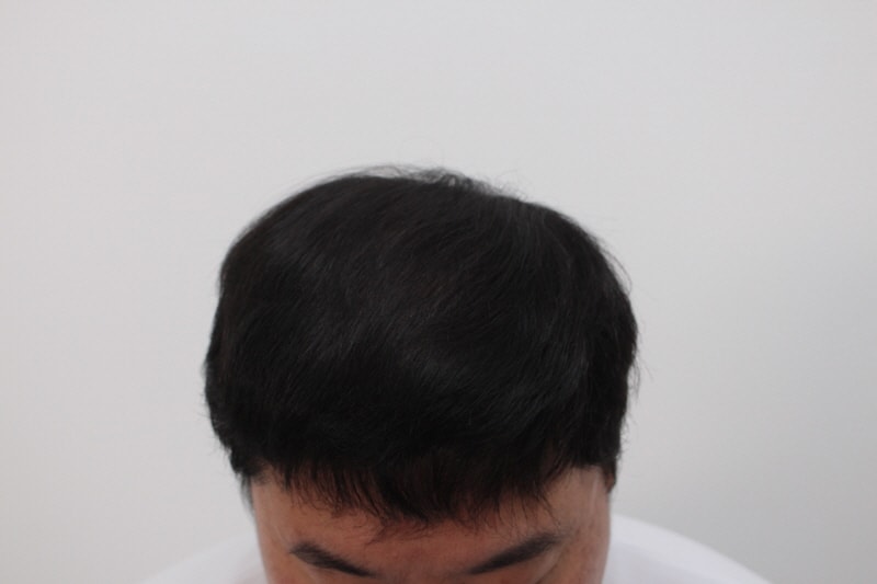 [크기변환]2. 수술후 12개월차.jpg
